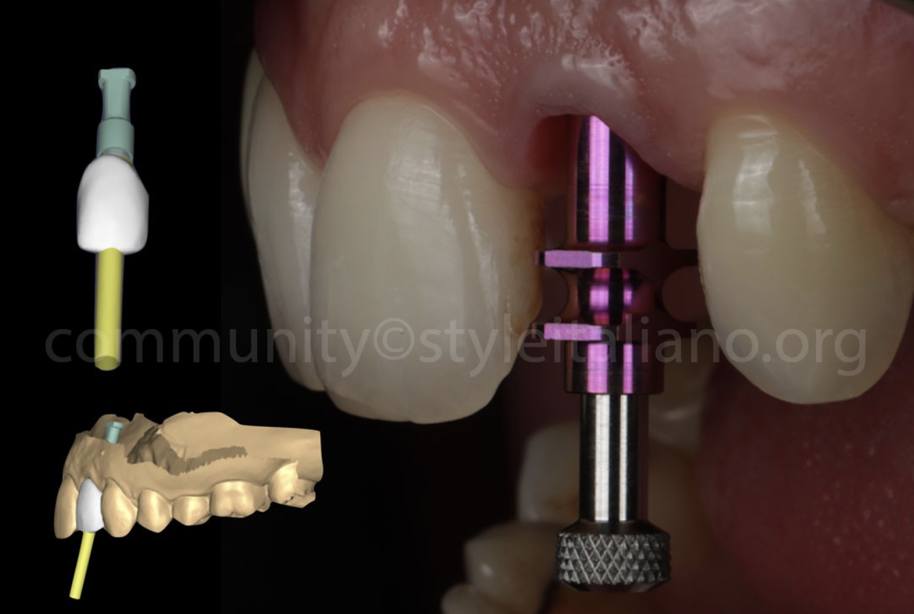 Điều Trị Lại Một Mão Răng Trên Implant: Tối ưu hoá kết quả bằng phần mềm OptiShade